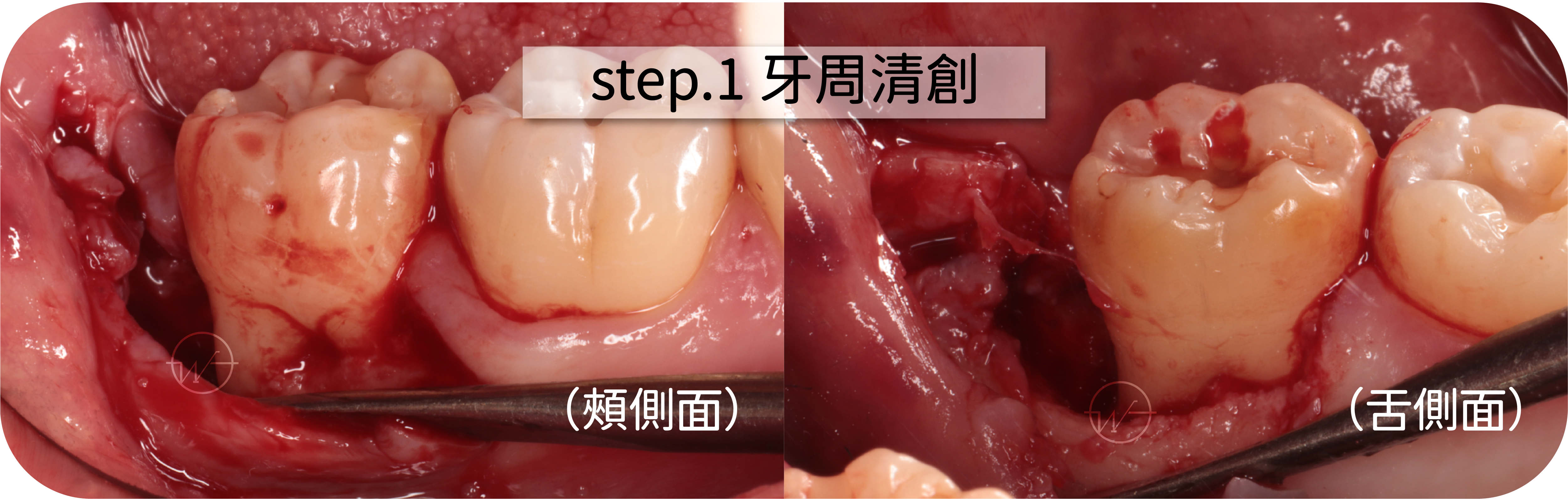 牙周再生手術 （DR.LU）